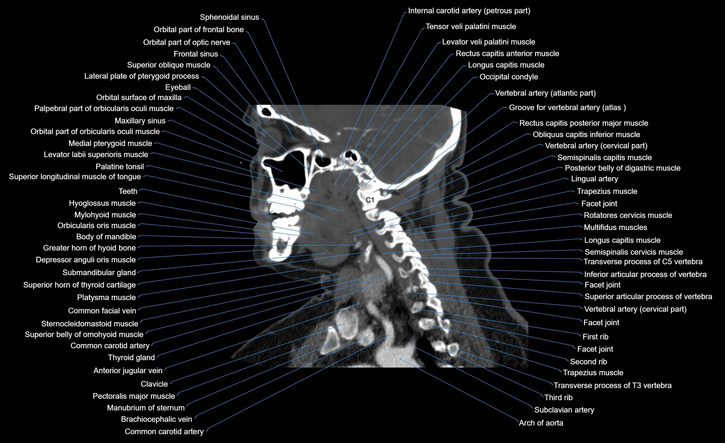 Neck CT sagittal cross sectional anatomy 3D  radiology  image-img-00001-00008.webp